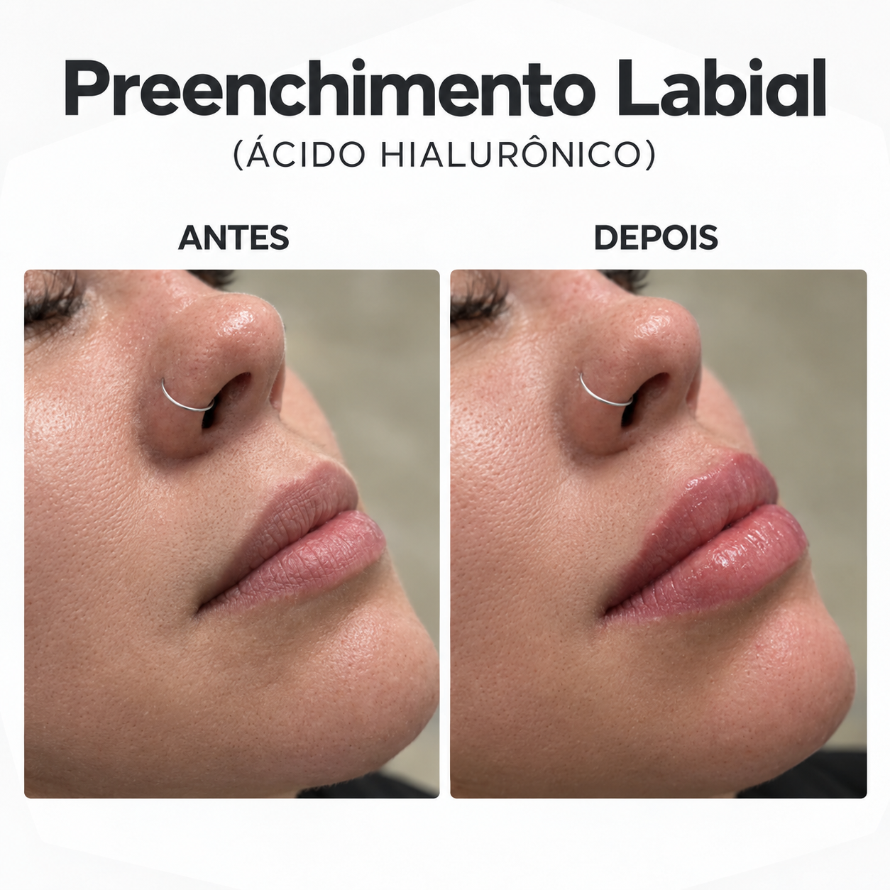 Antes e depois de harmonização labial, resultado natural